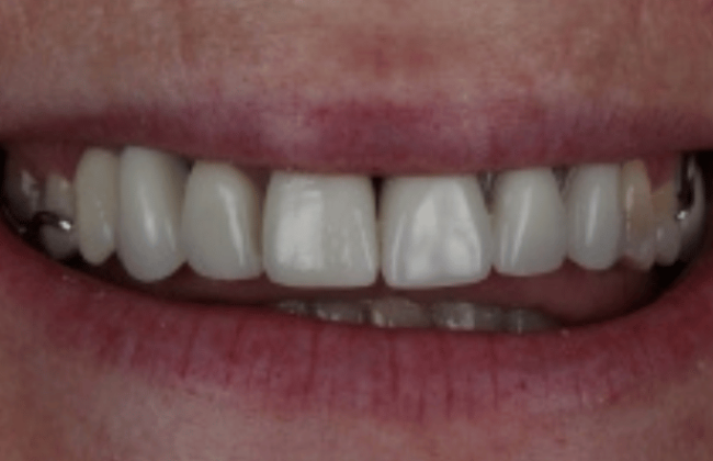 After (Teeth)