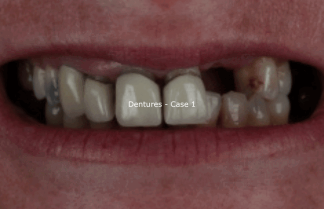 Before (Teeth)