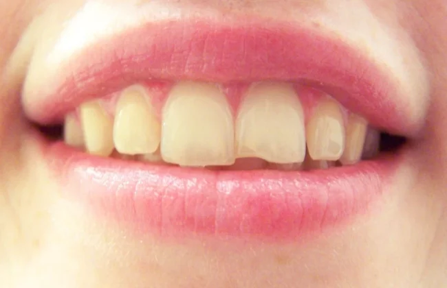 After (Teeth)
