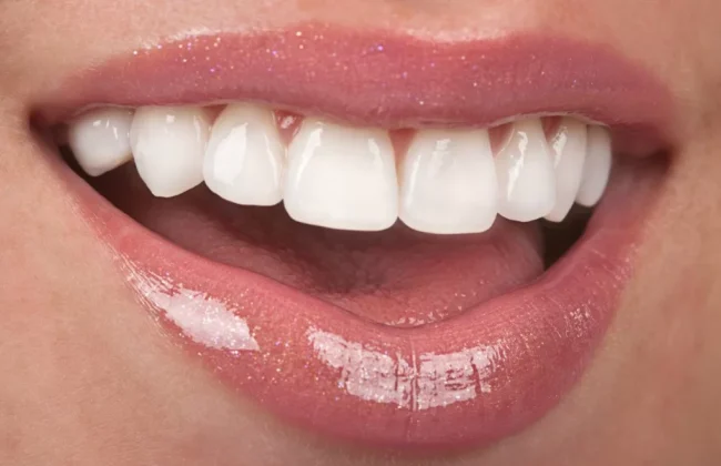 Before (Teeth)