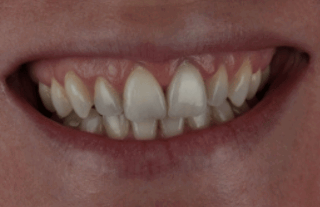 After (Teeth)