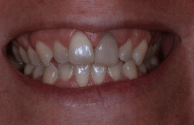 Before (Teeth)