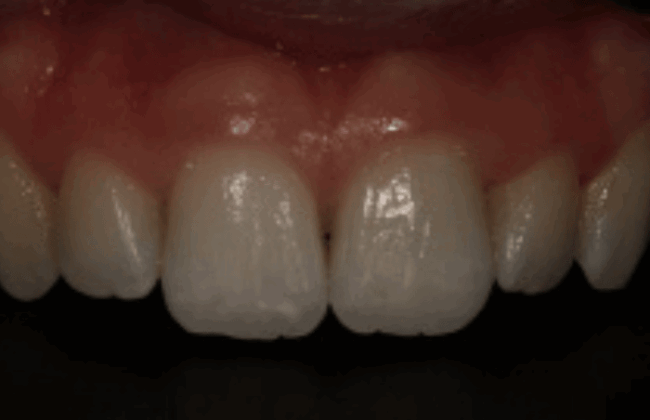 After (Teeth)