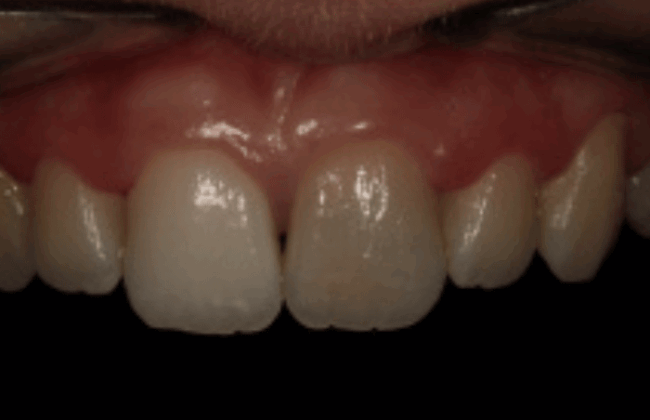 Before (Teeth)