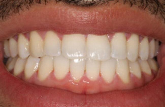 After (Teeth)