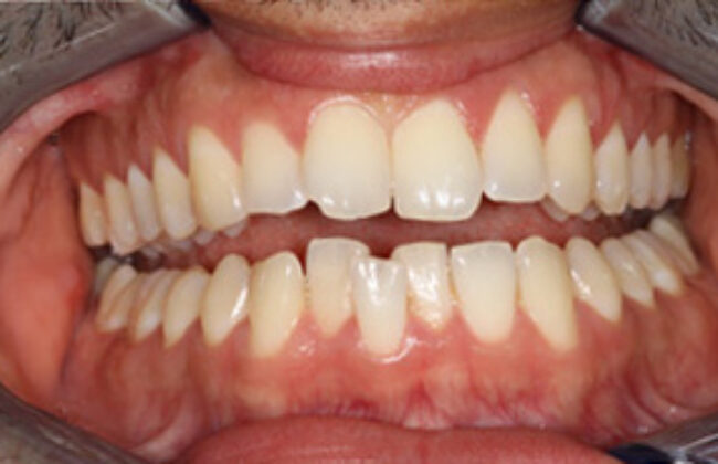 Before (Teeth)