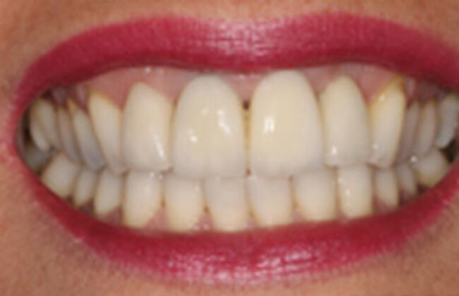 After (Teeth)