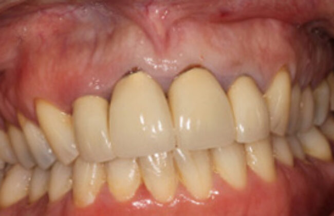 Before (Teeth)