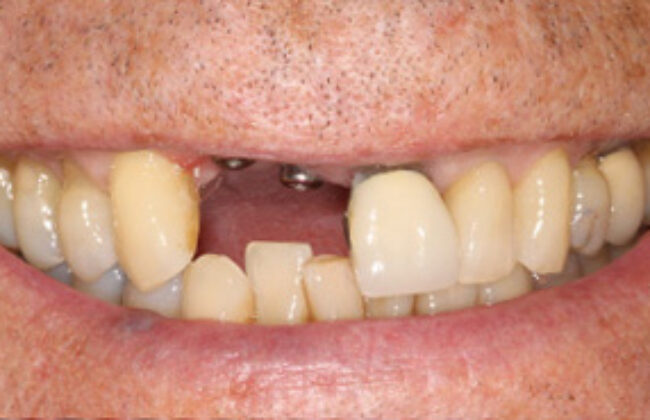 Before (Teeth)