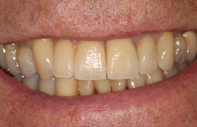 After (Teeth)