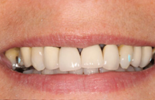 Before (Teeth)