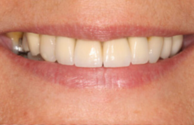 After (Teeth)