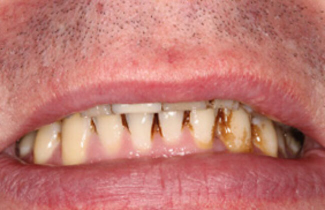 Before (Teeth)