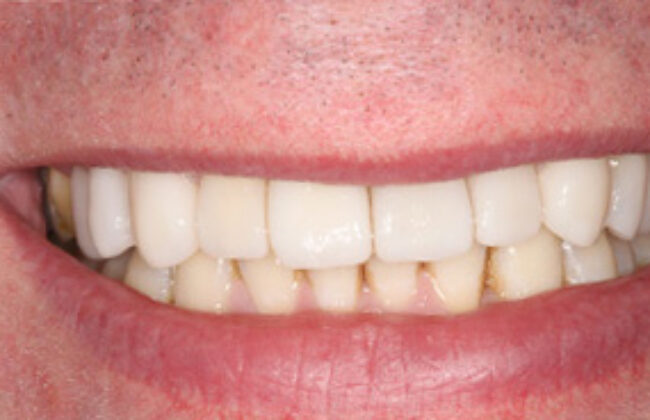 After (Teeth)