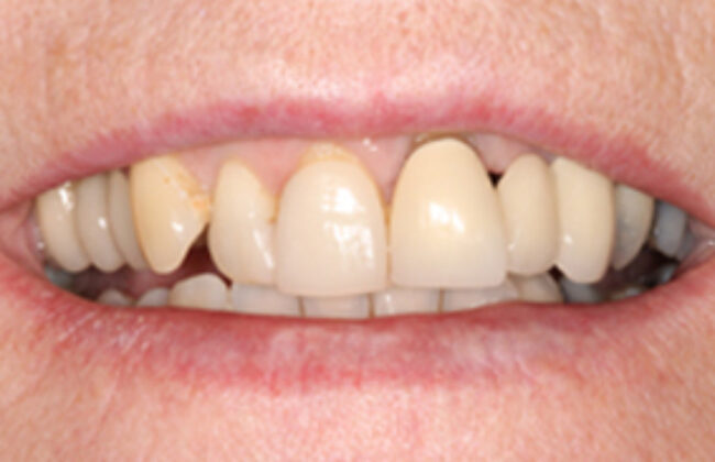 Before (Teeth)