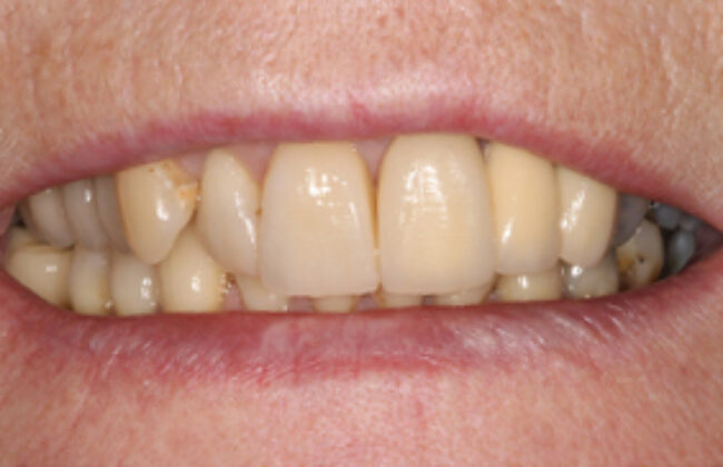 After (Teeth)