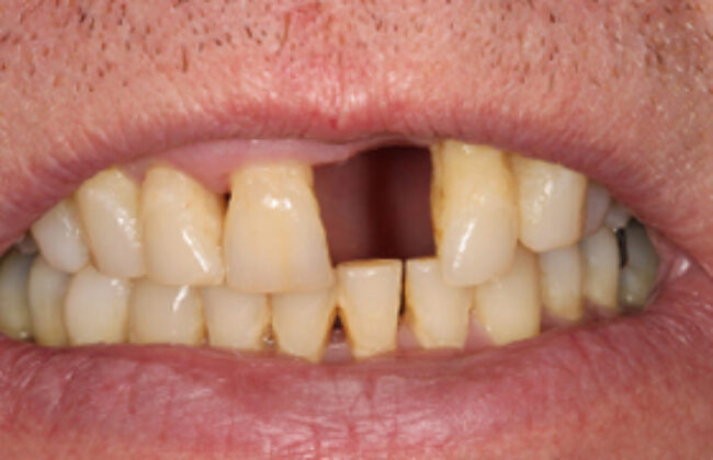 Before (Teeth)