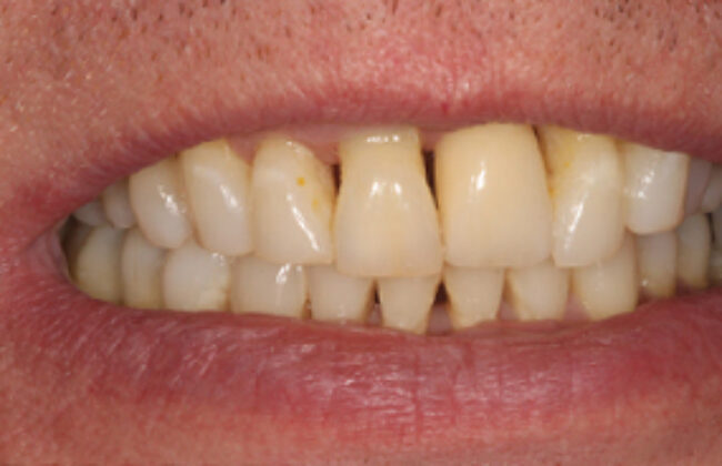 After (Teeth)