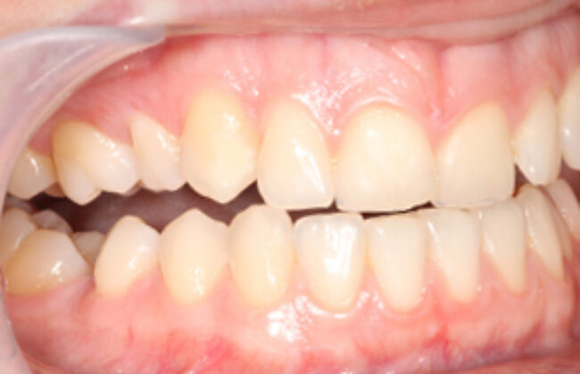 Before (Teeth)