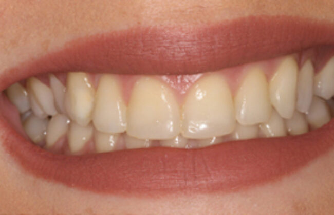After (Teeth)