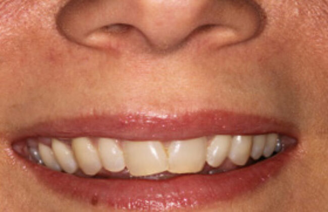 Before (Teeth)