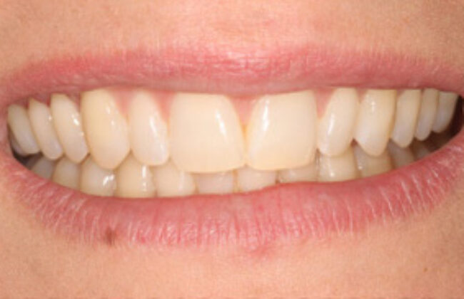 After (Teeth)
