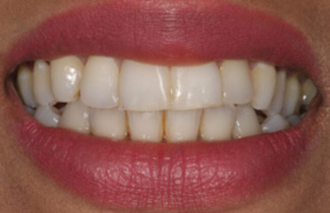After (Teeth)