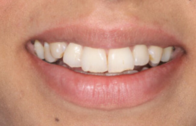 Before (Teeth)
