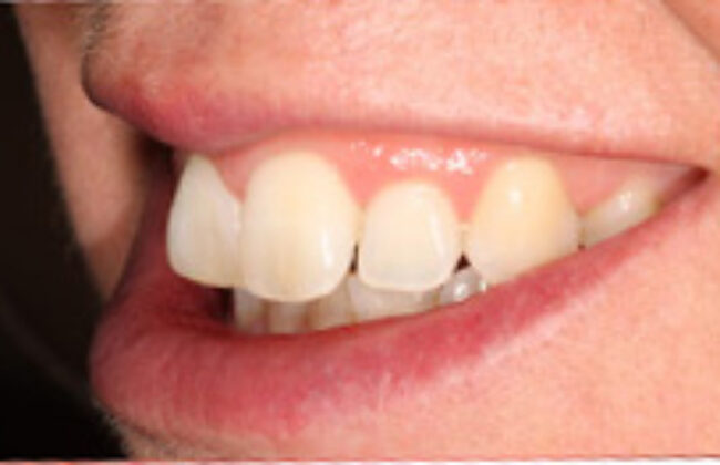 Before (Teeth)
