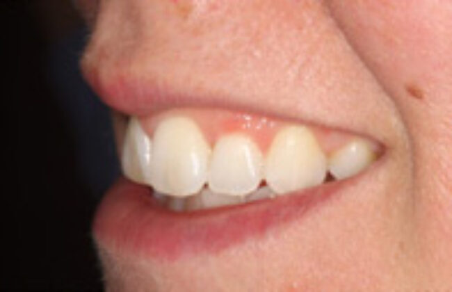 After (Teeth)