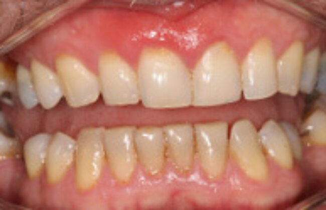 Before (Teeth)
