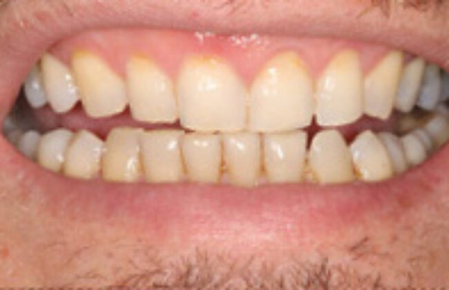 After (Teeth)