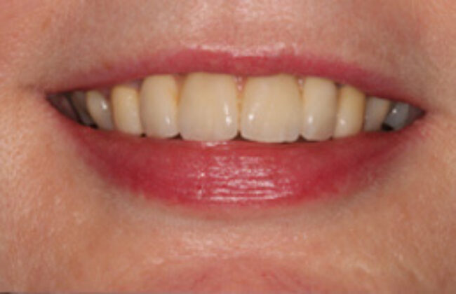 After (Teeth)