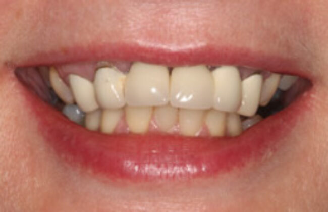 Before (Teeth)