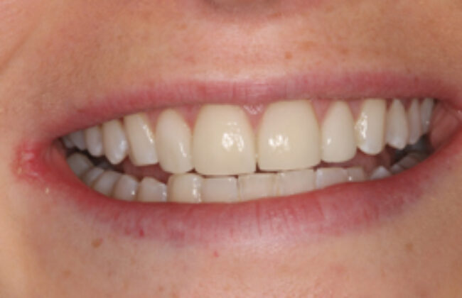 After (Teeth)