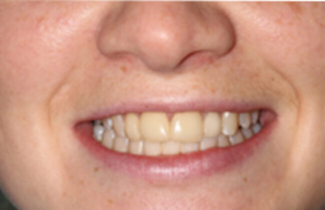 Before (Teeth)