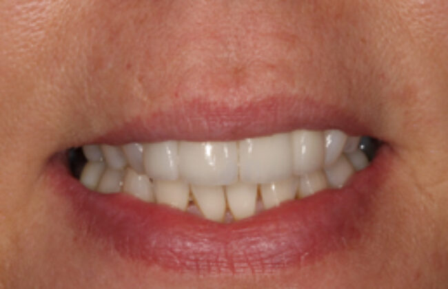 After (Teeth)