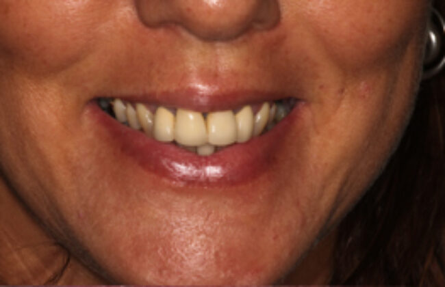 Before (Teeth)