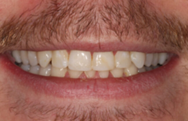 After (Teeth)