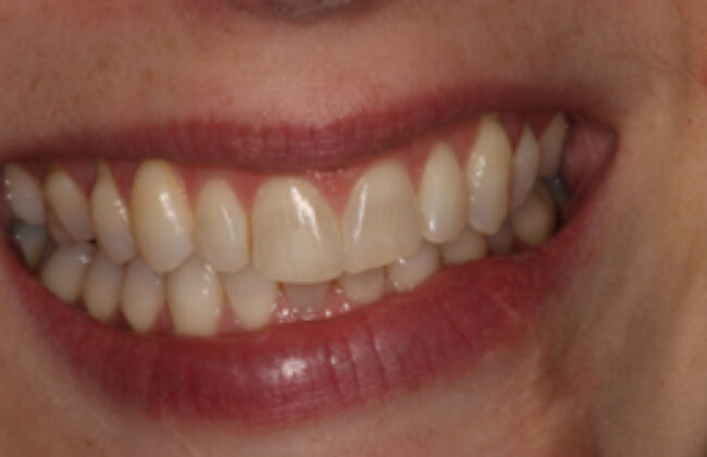 After (Teeth)