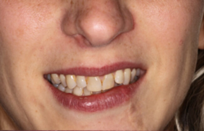 Before (Teeth)