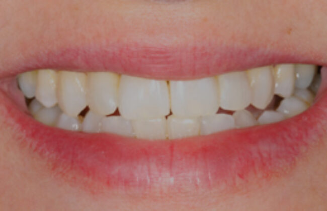 After (Teeth)