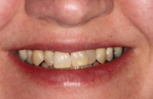 Before (Teeth)
