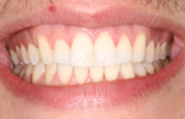 After (Teeth)