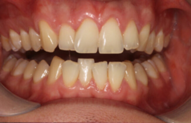 Before (Teeth)