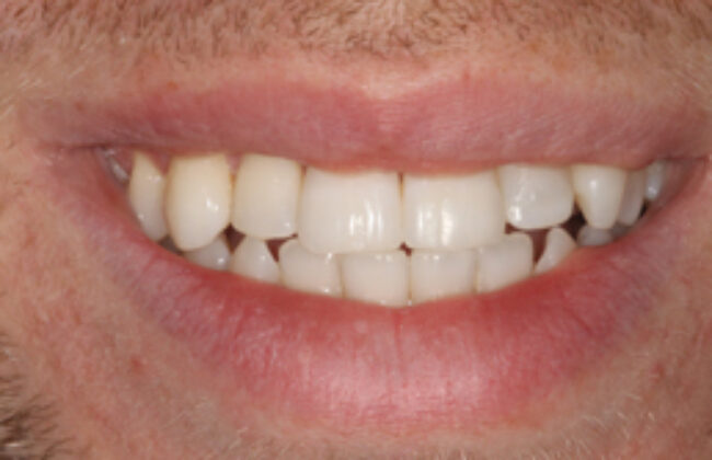 After (Teeth)