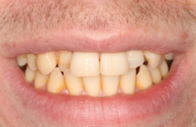 Before (Teeth)