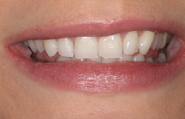 After (Teeth)