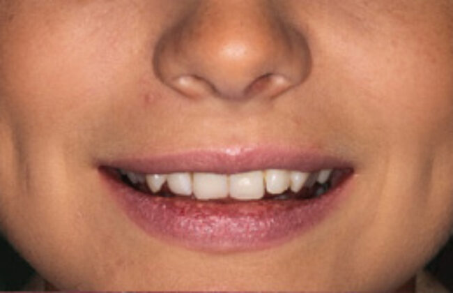 Before (Teeth)