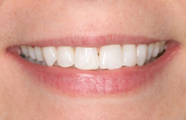 After (Teeth)